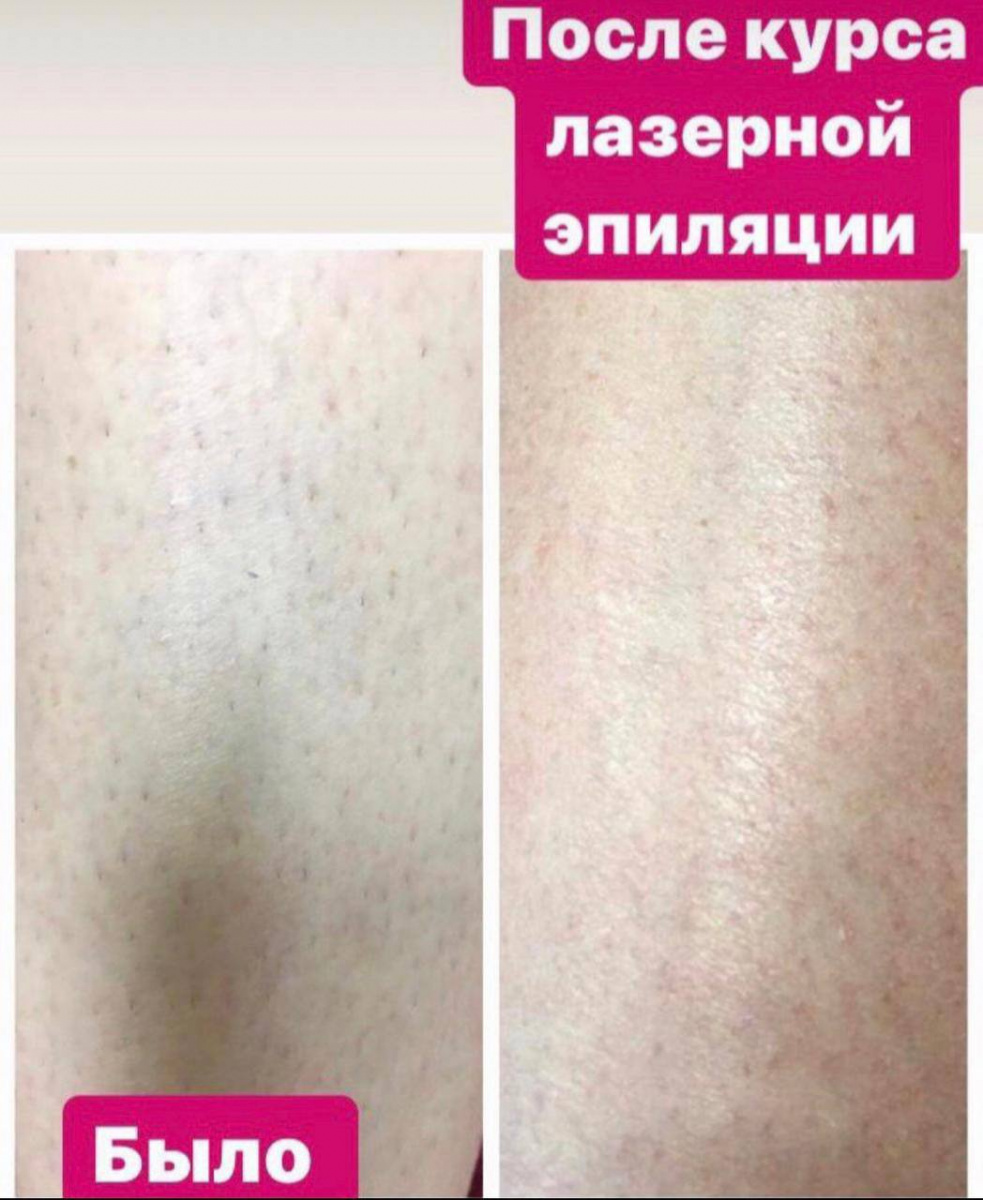 Body silk лазерная. Боди Силк лазерная эпиляция.